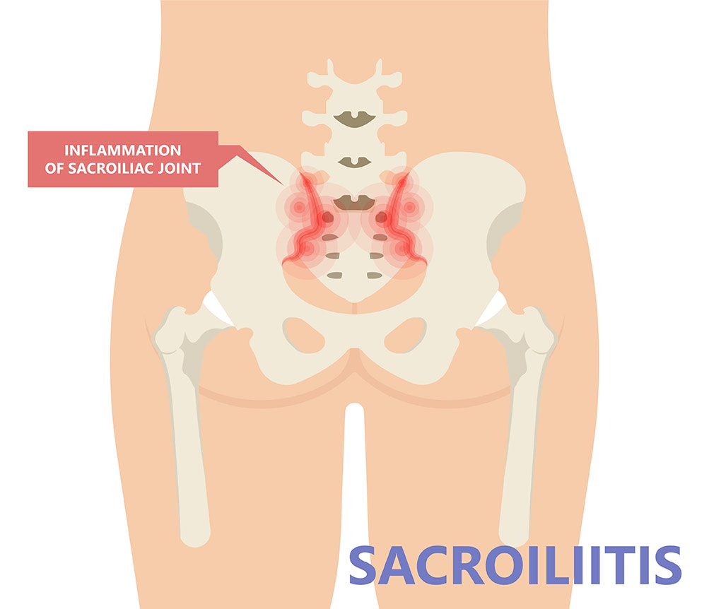 sacroiliac injection