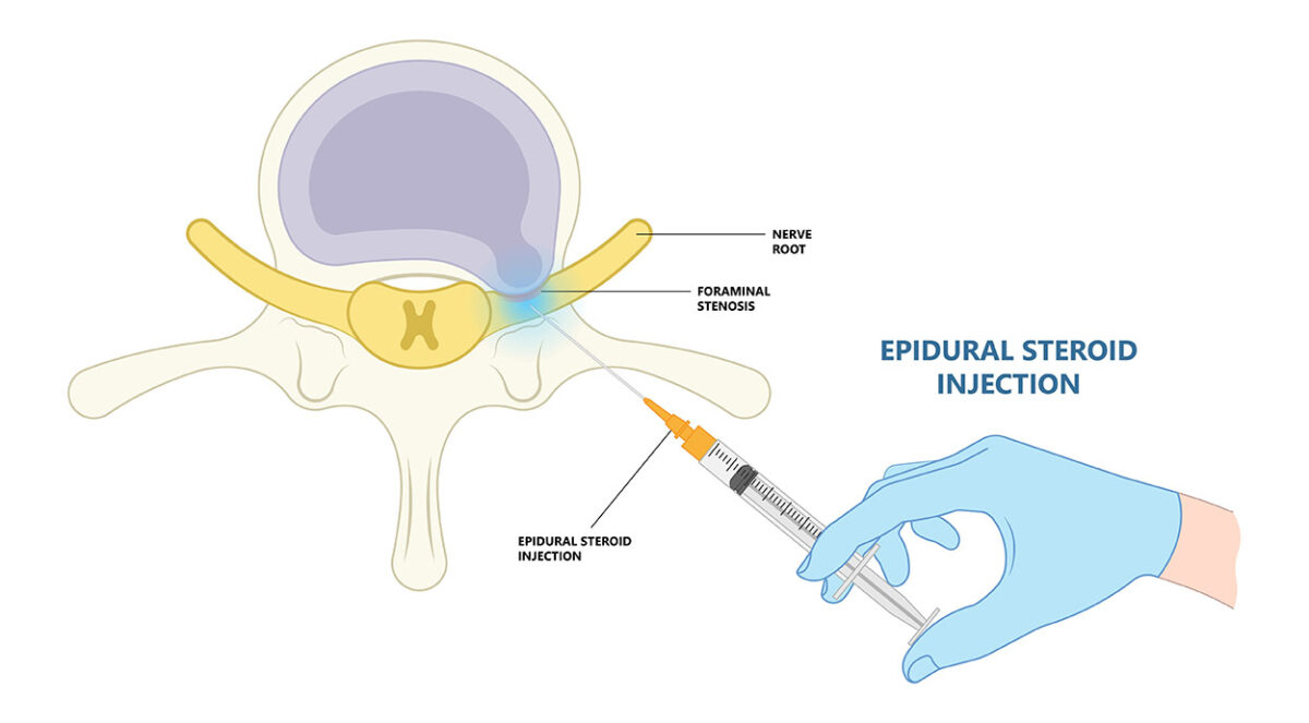 Epidural Steroid Injection